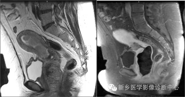 子宫内膜癌磁共振分期及图解