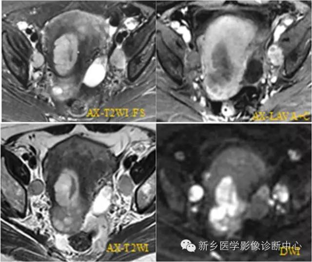 子宫内膜癌磁共振分期及图解