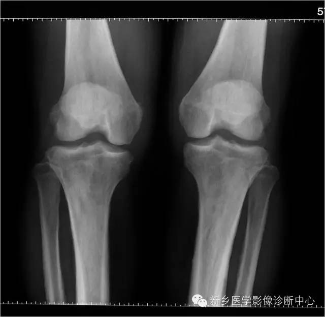 【病例】骨膜增生厚皮症1例X线影像表现 【病例】骨膜增生厚皮症1例X线影像表现