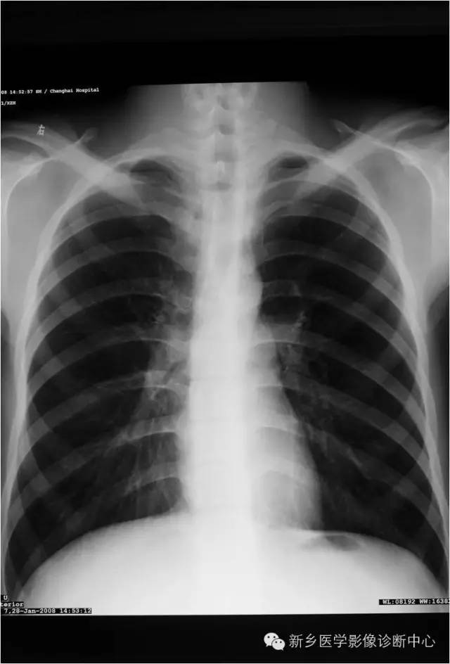 【病例】骨膜增生厚皮症1例X线影像表现 【病例】骨膜增生厚皮症1例X线影像表现