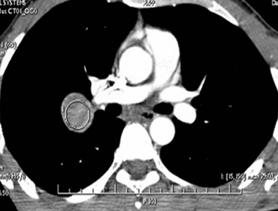 【病例】肺部巨淋巴结增生症1例CT影像表现 【病例】肺部巨淋巴结增生症1例CT影像表现