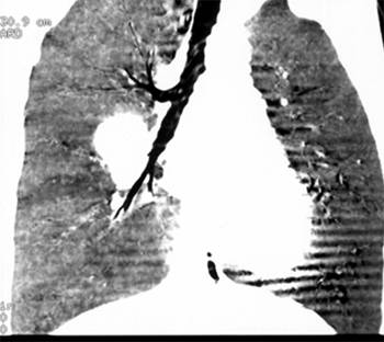 【病例】肺部巨淋巴结增生症1例CT影像表现 【病例】肺部巨淋巴结增生症1例CT影像表现
