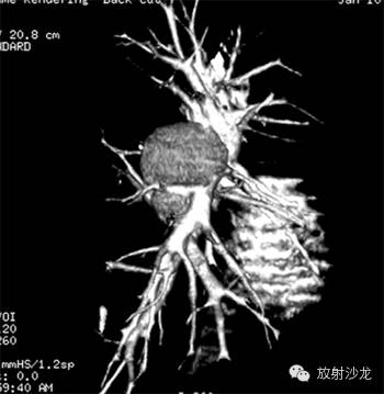 【病例】肺部巨淋巴结增生症1例CT影像表现
