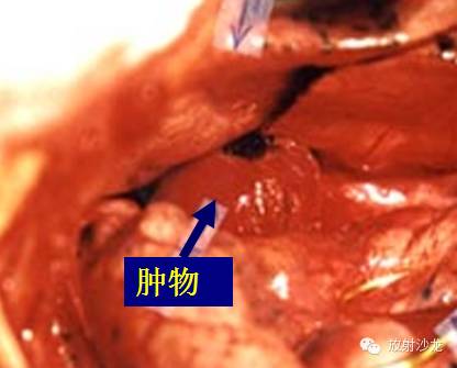 【病例】肺部巨淋巴结增生症1例CT影像表现 【病例】肺部巨淋巴结增生症1例CT影像表现