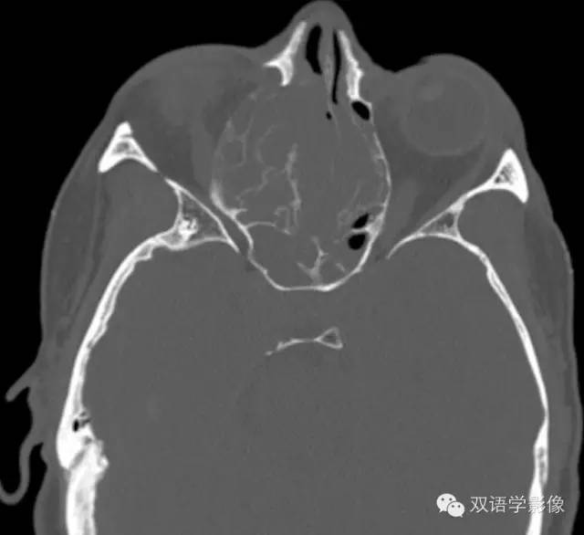 【双语病例】嗅神经母细胞瘤1例MR影像特点