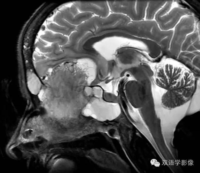 【双语病例】嗅神经母细胞瘤1例MR影像特点 【双语病例】嗅神经母细胞瘤1例MR影像特点