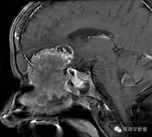 【双语病例】嗅神经母细胞瘤1例MR影像特点 【双语病例】嗅神经母细胞瘤1例MR影像特点