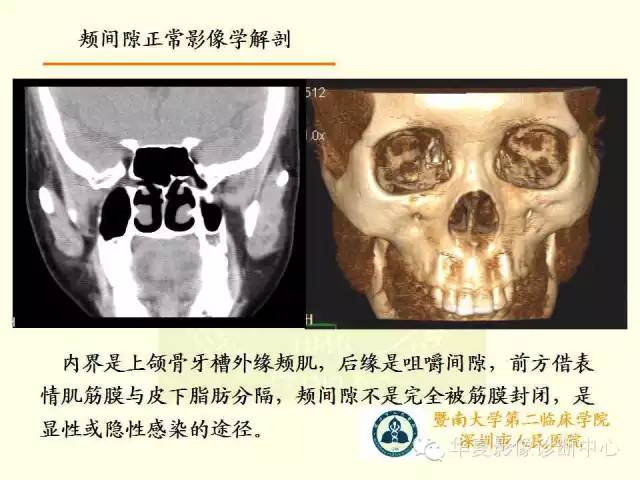 【PPT】颊间隙影像学解剖与病变的诊断