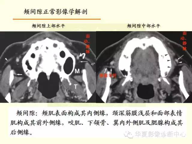【PPT】颊间隙影像学解剖与病变的诊断