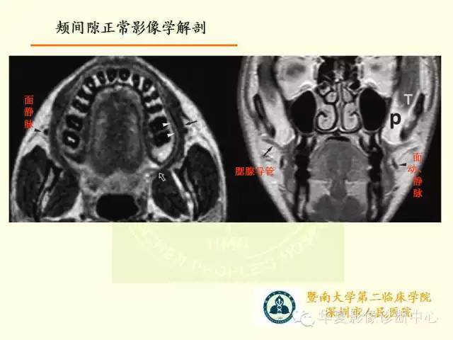 【PPT】颊间隙影像学解剖与病变的诊断