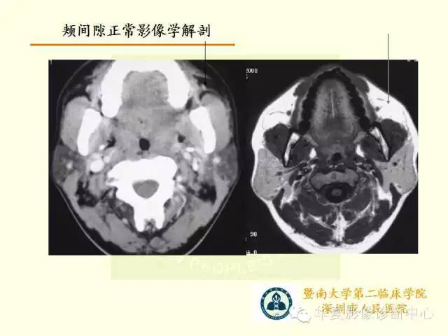 【PPT】颊间隙影像学解剖与病变的诊断