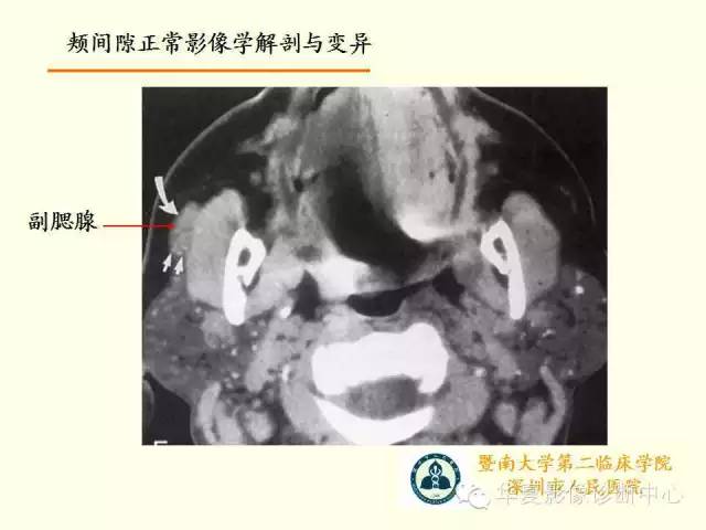 【PPT】颊间隙影像学解剖与病变的诊断