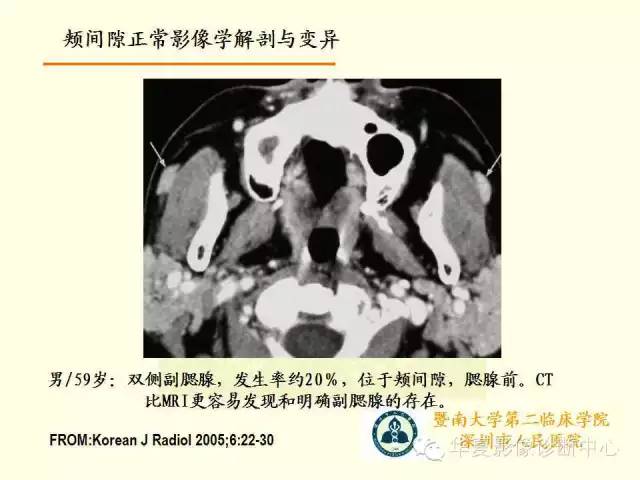 【PPT】颊间隙影像学解剖与病变的诊断