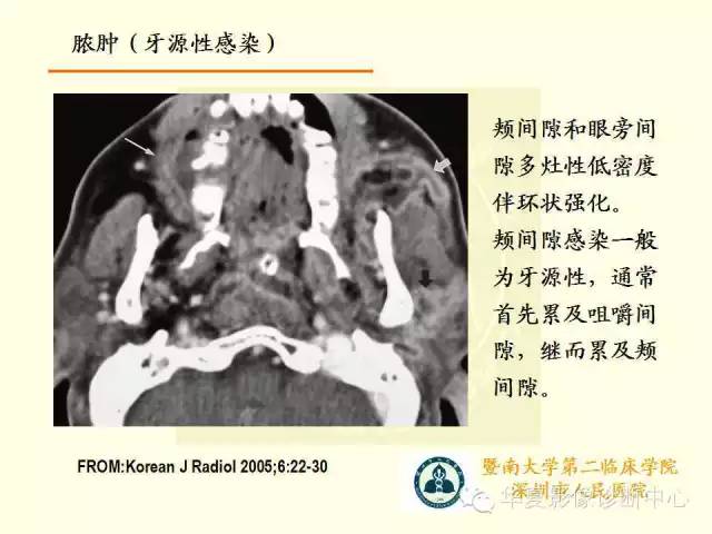 【PPT】颊间隙影像学解剖与病变的诊断