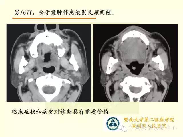 【PPT】颊间隙影像学解剖与病变的诊断