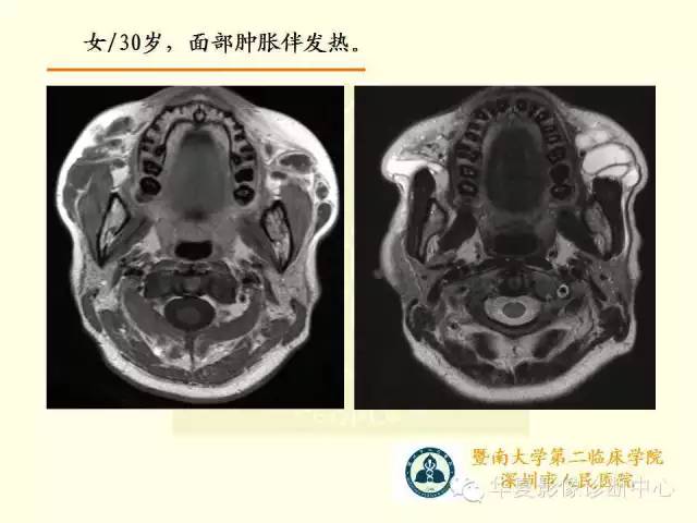 【PPT】颊间隙影像学解剖与病变的诊断