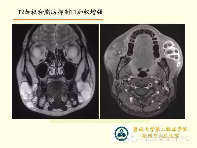 【PPT】颊间隙影像学解剖与病变的诊断