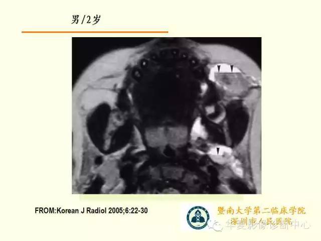 【PPT】颊间隙影像学解剖与病变的诊断