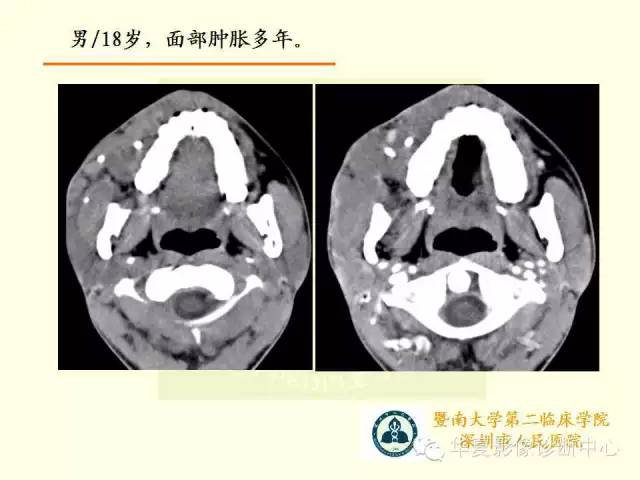 【PPT】颊间隙影像学解剖与病变的诊断