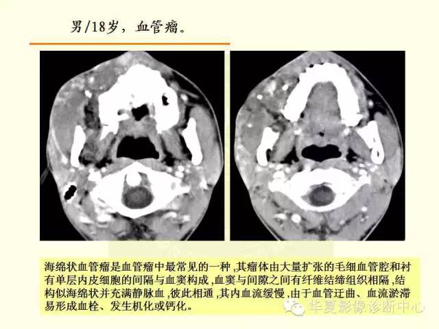 【PPT】颊间隙影像学解剖与病变的诊断