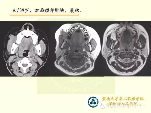 【PPT】颊间隙影像学解剖与病变的诊断