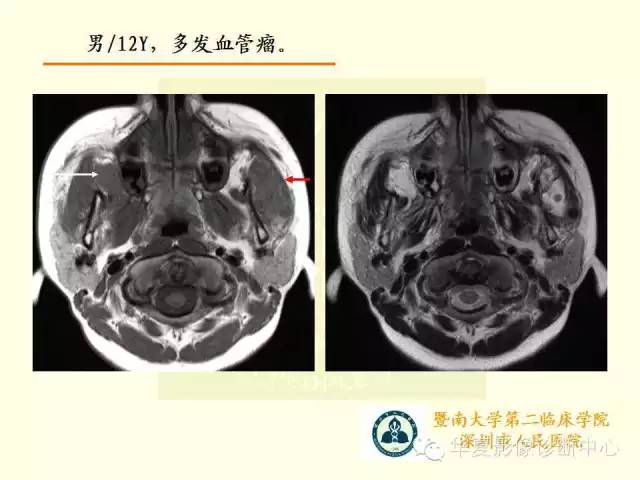 【PPT】颊间隙影像学解剖与病变的诊断