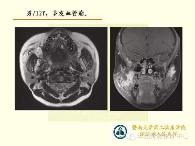 【PPT】颊间隙影像学解剖与病变的诊断