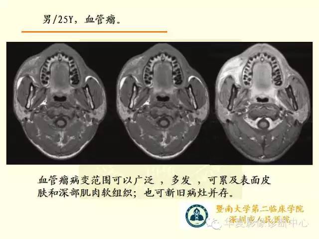 【PPT】颊间隙影像学解剖与病变的诊断
