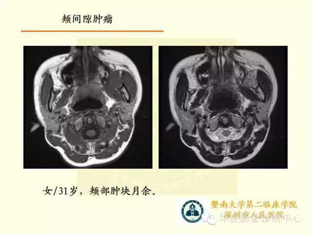 【PPT】颊间隙影像学解剖与病变的诊断
