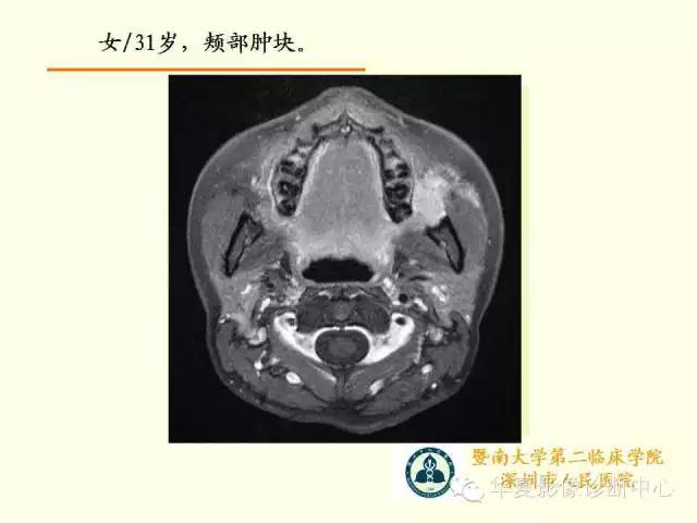 【PPT】颊间隙影像学解剖与病变的诊断