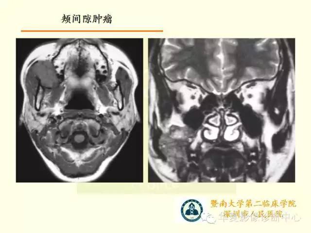 【PPT】颊间隙影像学解剖与病变的诊断