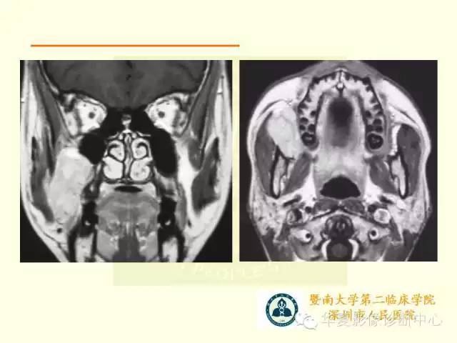 【PPT】颊间隙影像学解剖与病变的诊断