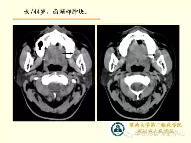 【PPT】颊间隙影像学解剖与病变的诊断
