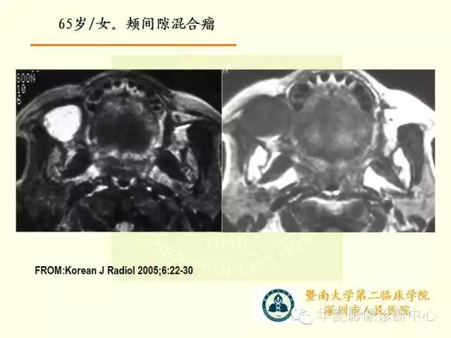 【PPT】颊间隙影像学解剖与病变的诊断