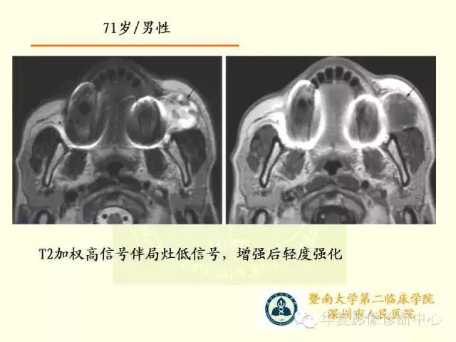 【PPT】颊间隙影像学解剖与病变的诊断