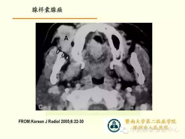 【PPT】颊间隙影像学解剖与病变的诊断