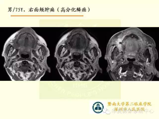 【PPT】颊间隙影像学解剖与病变的诊断