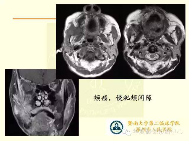 【PPT】颊间隙影像学解剖与病变的诊断