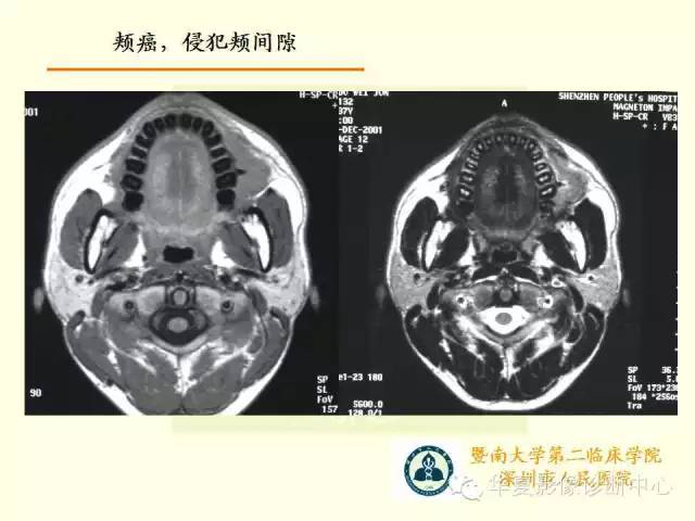 【PPT】颊间隙影像学解剖与病变的诊断