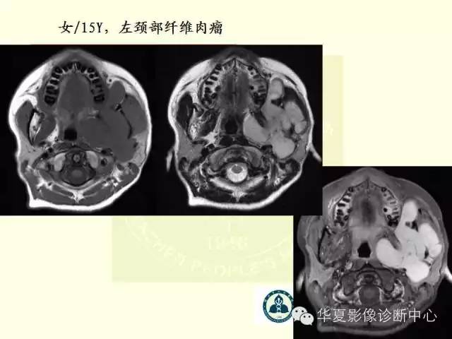 【PPT】颊间隙影像学解剖与病变的诊断
