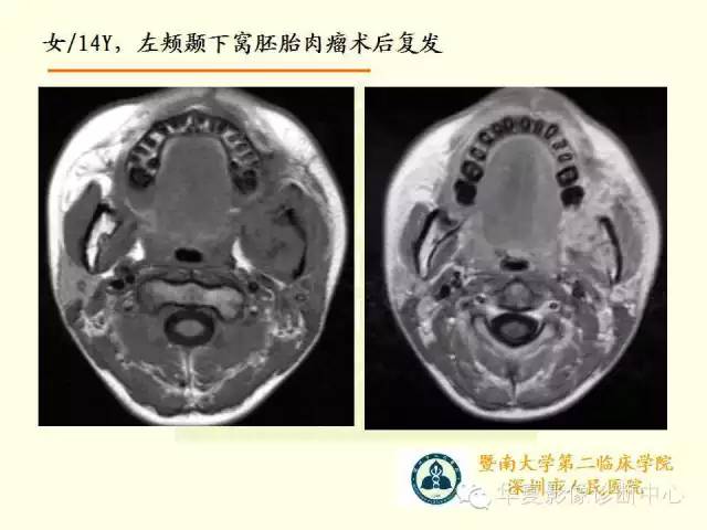 【PPT】颊间隙影像学解剖与病变的诊断