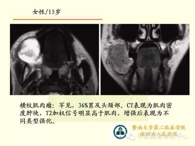 【PPT】颊间隙影像学解剖与病变的诊断