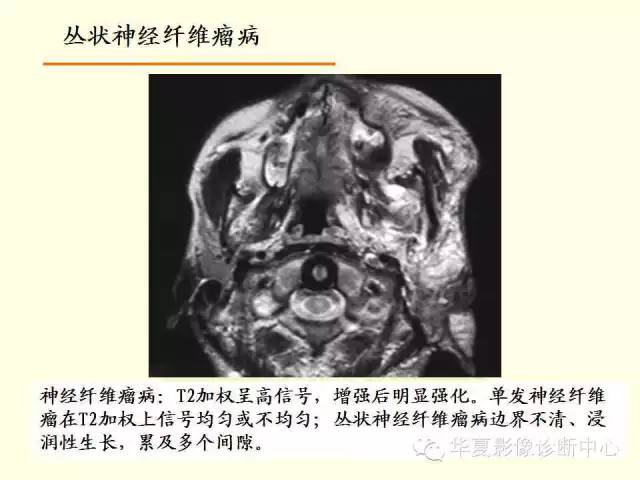 【PPT】颊间隙影像学解剖与病变的诊断