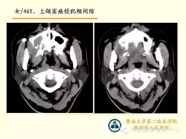 【PPT】颊间隙影像学解剖与病变的诊断