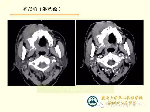 【PPT】颊间隙影像学解剖与病变的诊断