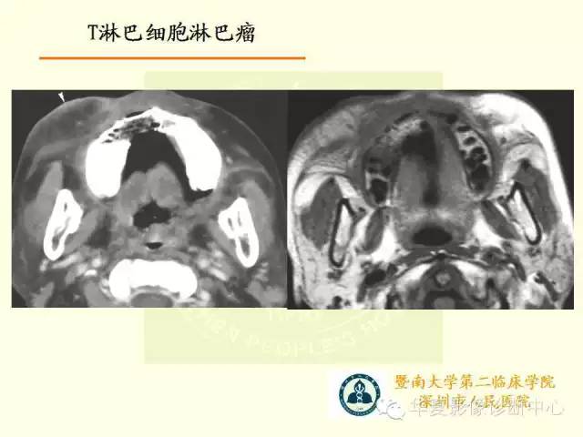 【PPT】颊间隙影像学解剖与病变的诊断