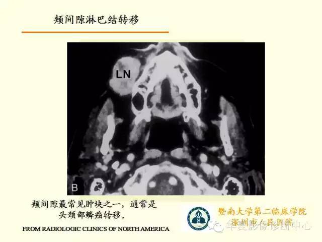 【PPT】颊间隙影像学解剖与病变的诊断