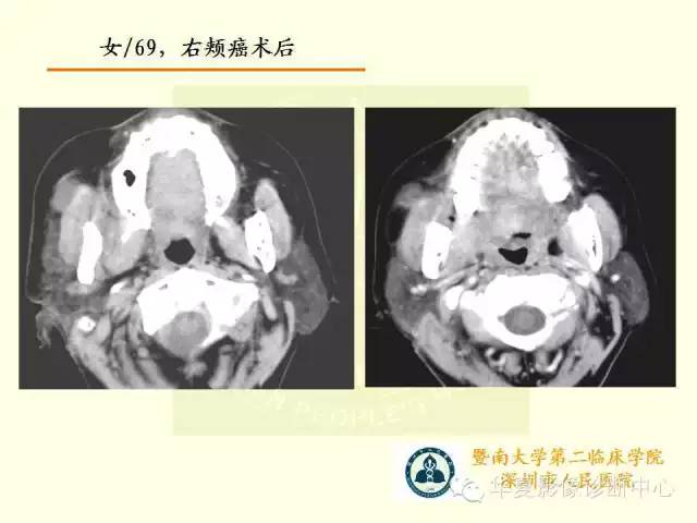 【PPT】颊间隙影像学解剖与病变的诊断