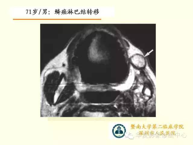 【PPT】颊间隙影像学解剖与病变的诊断