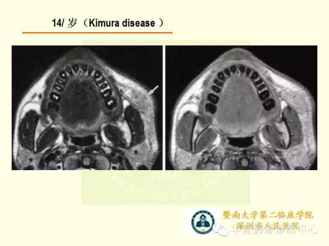 【PPT】颊间隙影像学解剖与病变的诊断